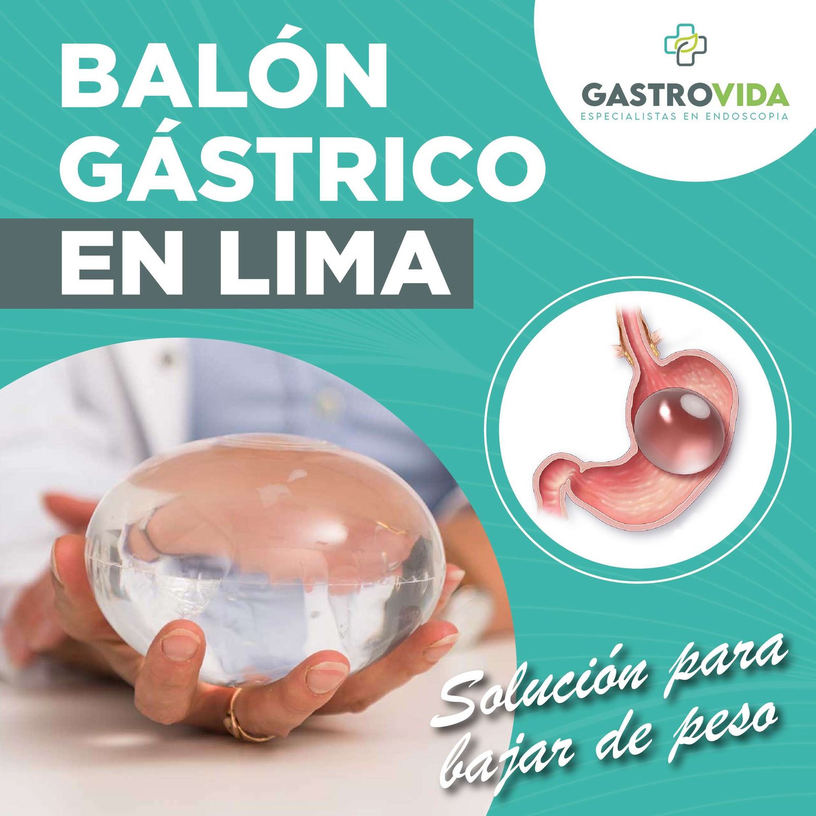 balon-gastrico-lima