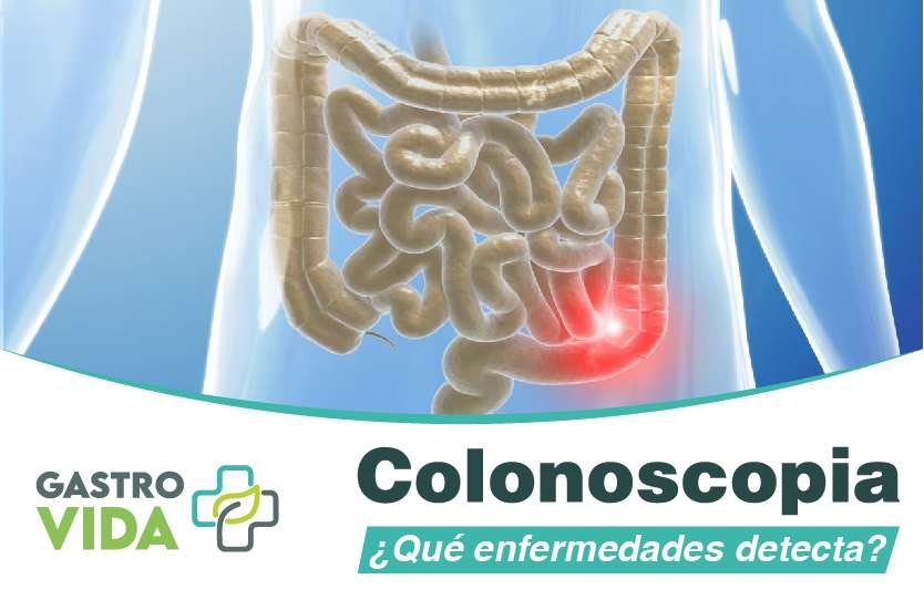 colonoscopia-que-enfemedades-detecta