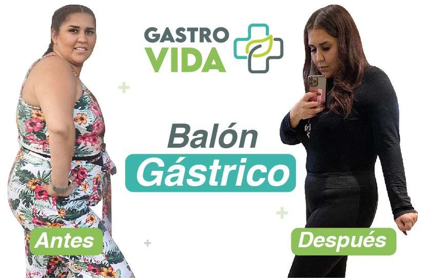 Balón Gástrico - Antes y Después