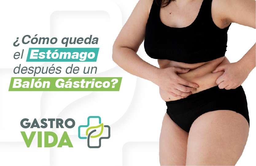 como-queda-el-estomago-despues del-balón-gastrico